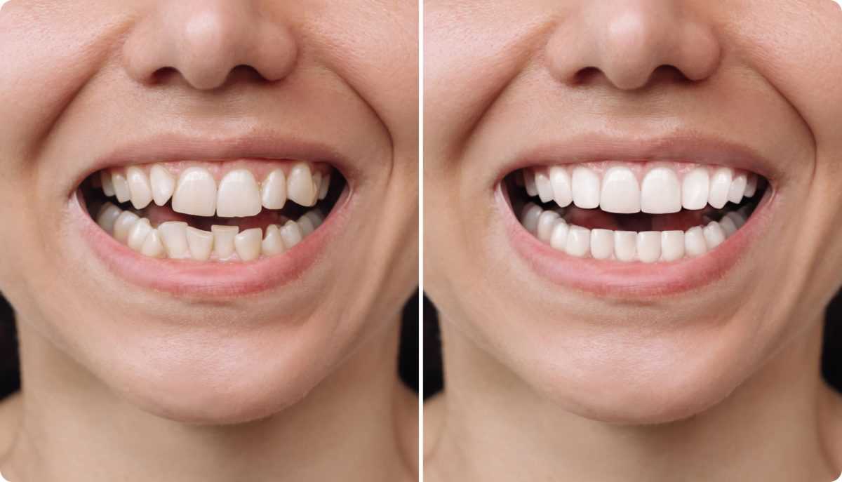 operación dientes en teruel antes y después