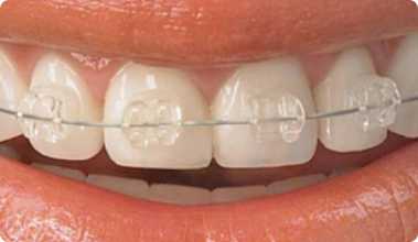 f-ortodoncia-estetica