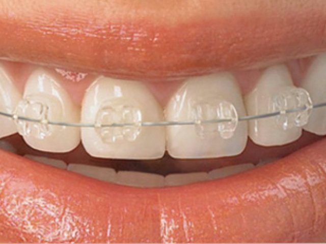 Ortodoncia Estética